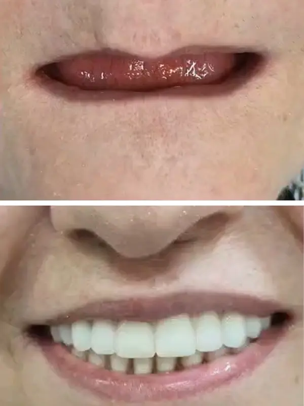 antes e depois (1)
