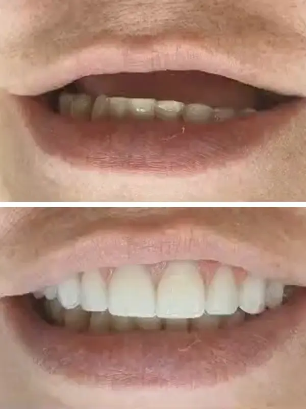antes e depois (4)