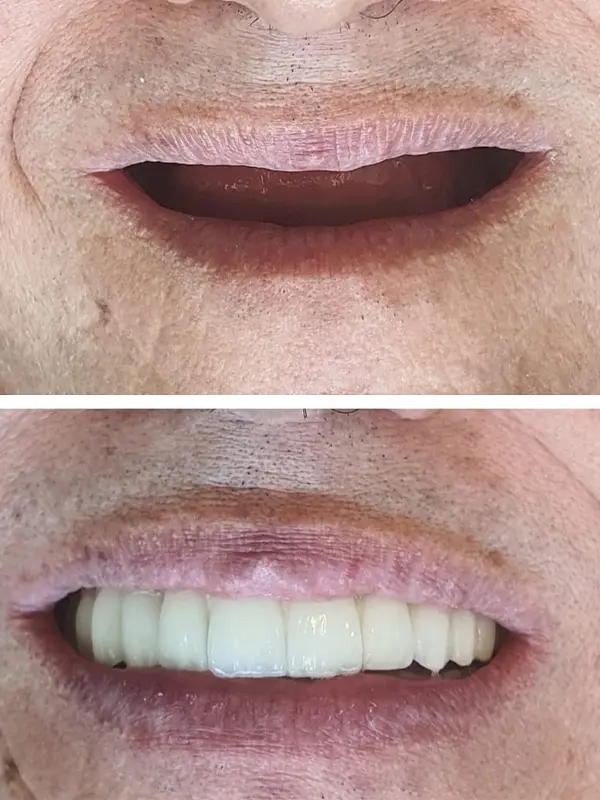 antes e depois (7)