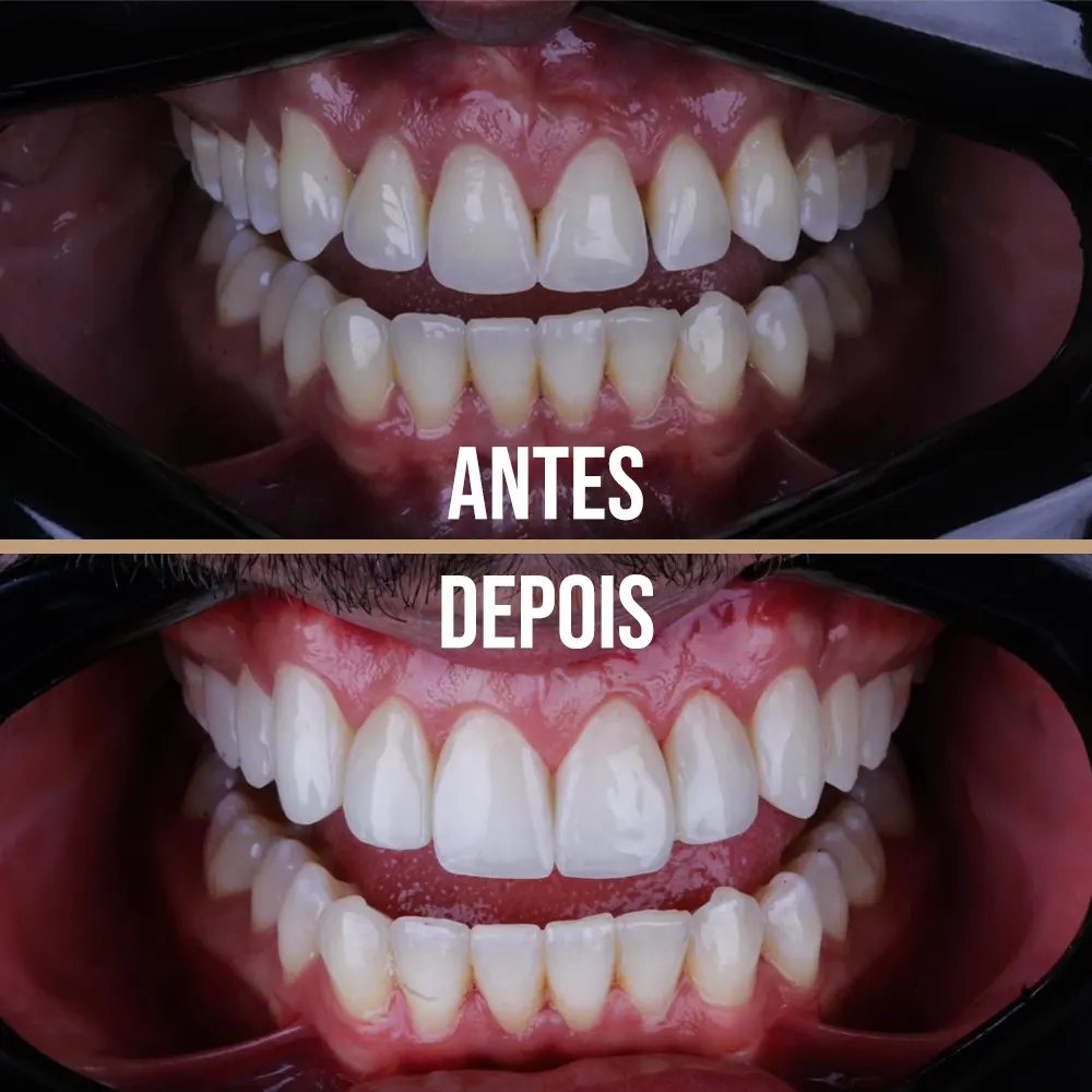 Antes e depois de Facetas em Resina